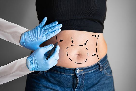 Liposuction: Procedure, Risks, and Results